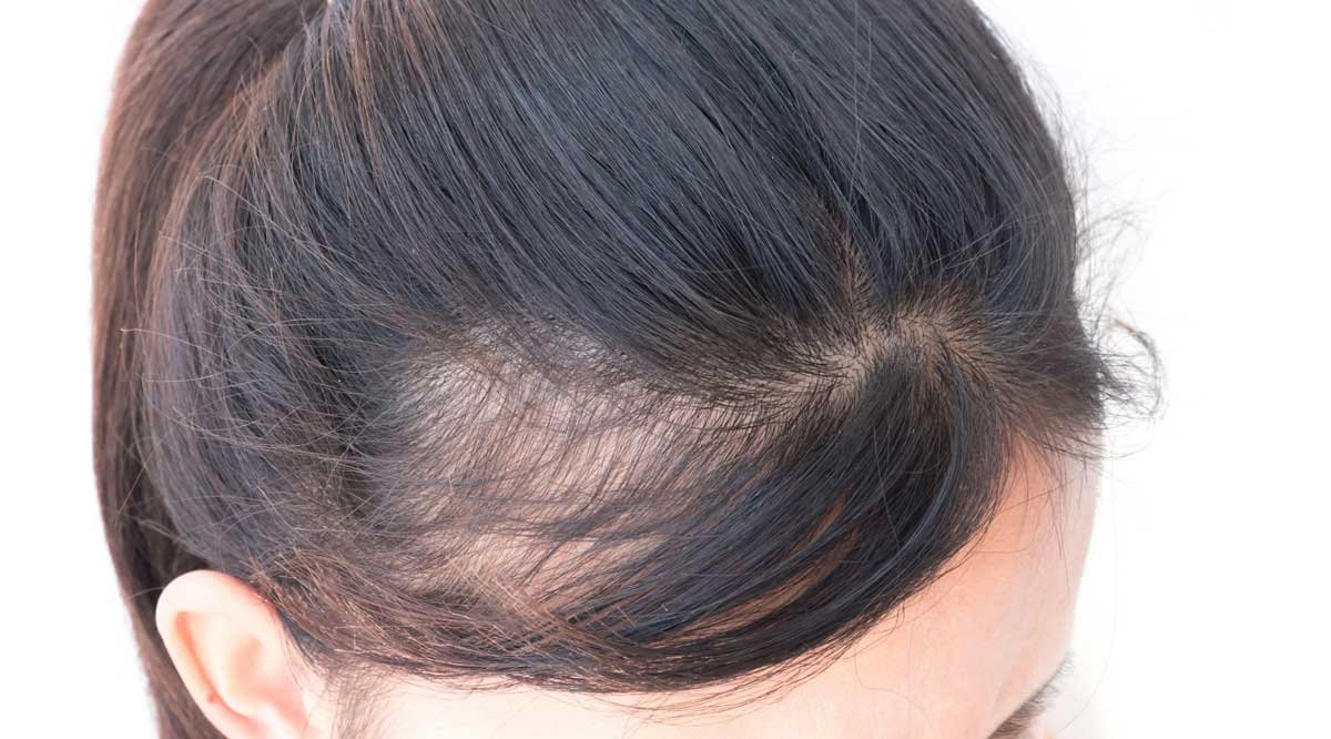 Androgenic Alopecia 