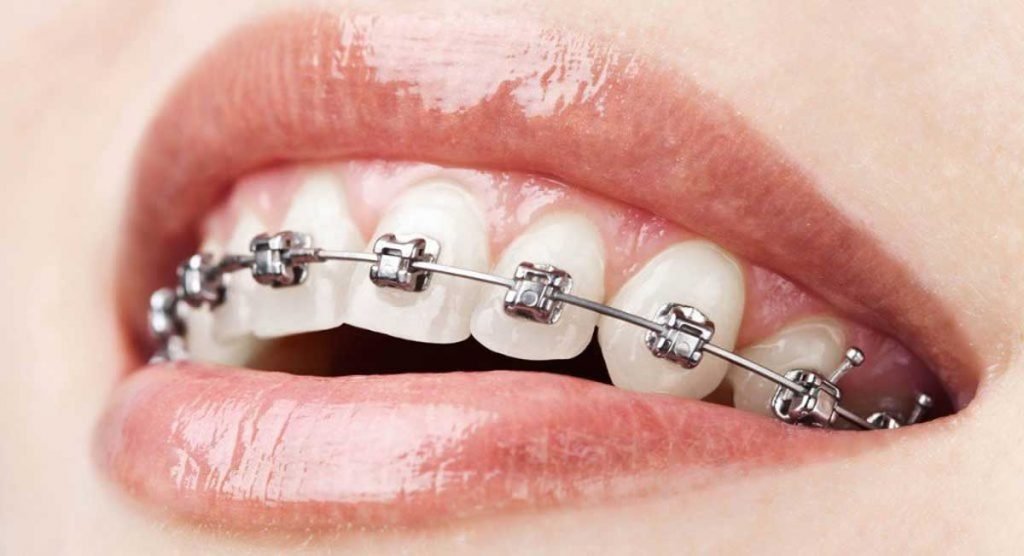 Why Braces are Now More Affordable Than Ever Before Braces