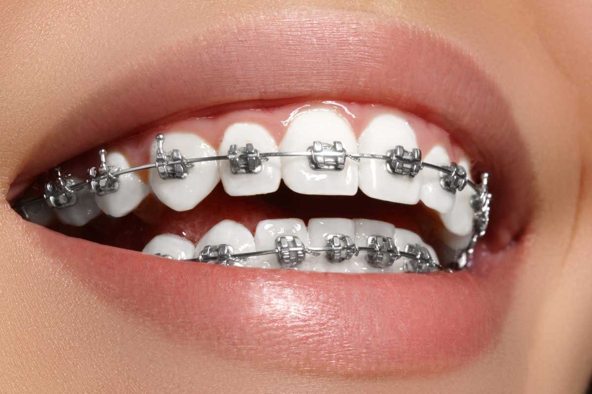 Braces are Now More Affordable Than Ever Before