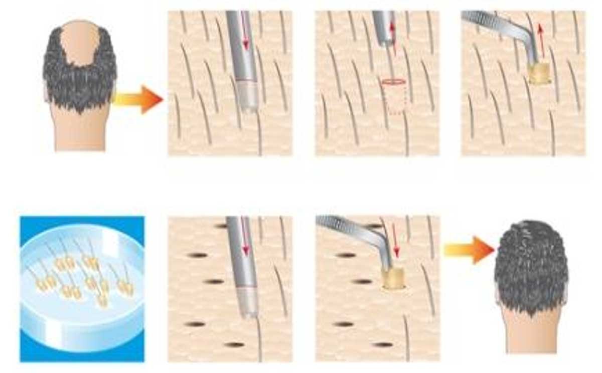 FUE-transplantation-method