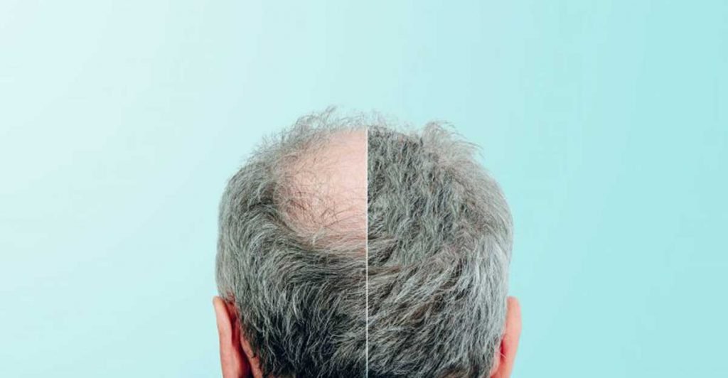 Hair transplantation by FUE method Hair transplantation by FUE method