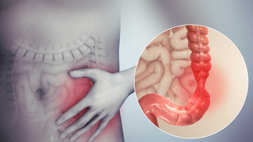 6 Tips For Living A Normal Life With Irritable Bowel Syndrome Irritable Bowel Syndrome