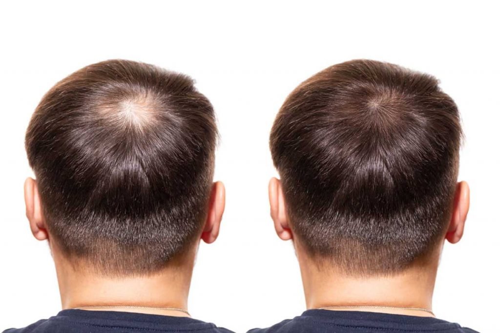 Hair Transplant