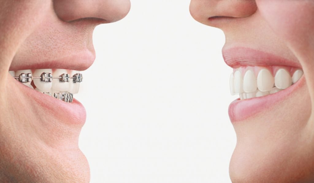 6 Top Reasons to Choose Invisalign Over Braces
