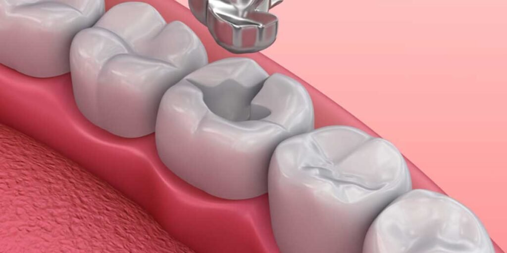 How To Handle Lost Fillings or Crowns Until You See the Dentist How To Handle Lost Fillings or Crowns Until You See the Dentist
